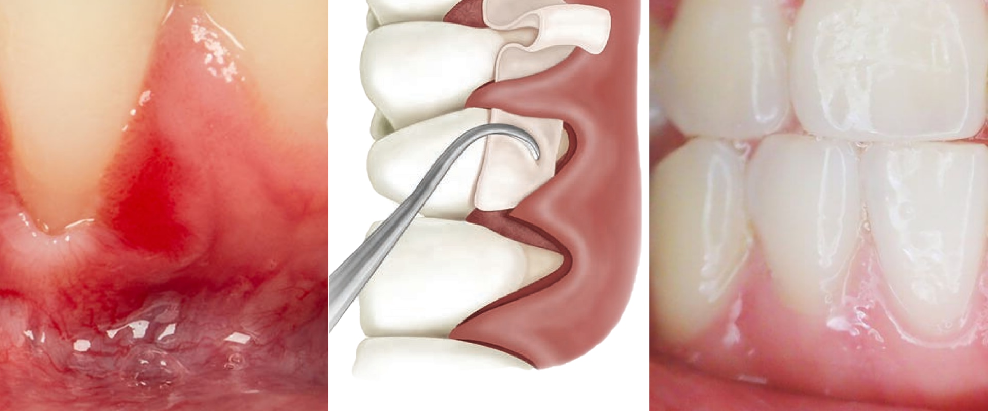 Expert Insights: Natural Ways to Treat Receding Gums