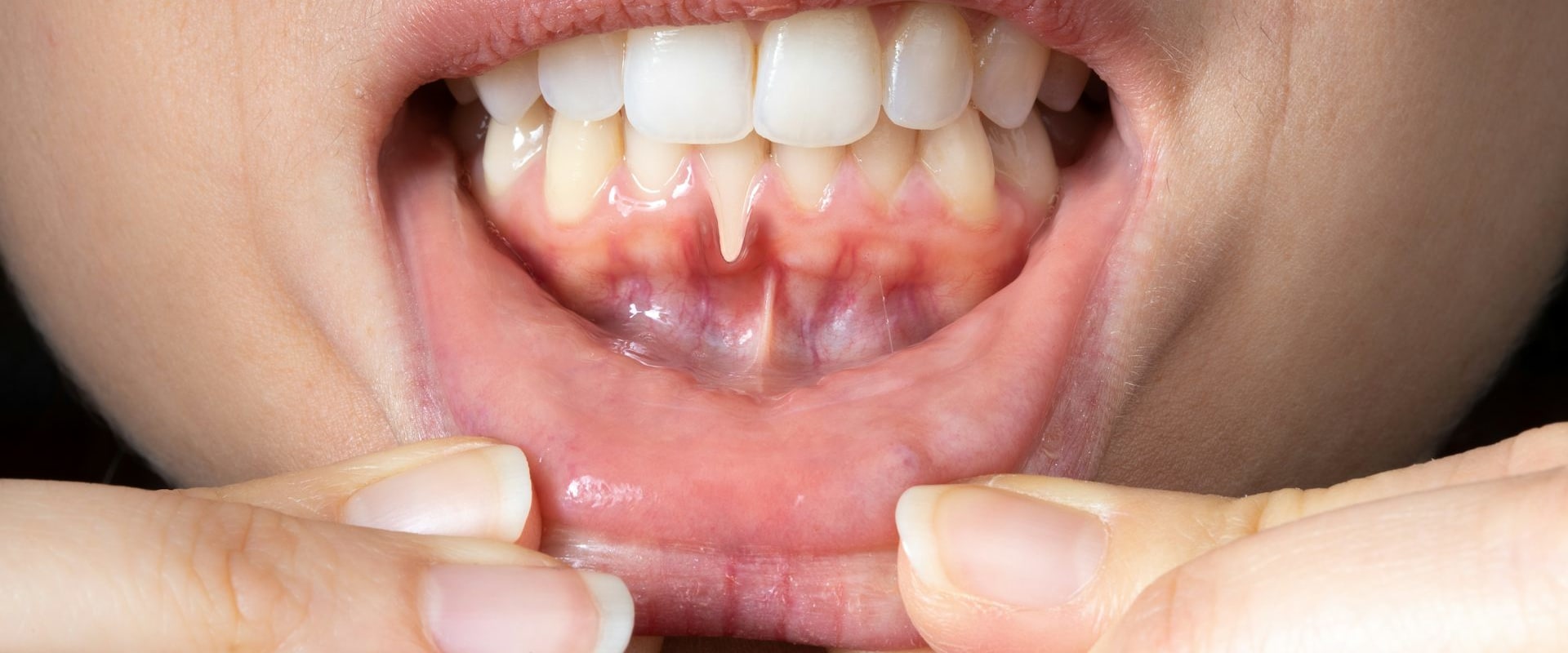 The Connection Between Gum Disease and Receding Gums: Natural Remedies for a Healthy Smile
