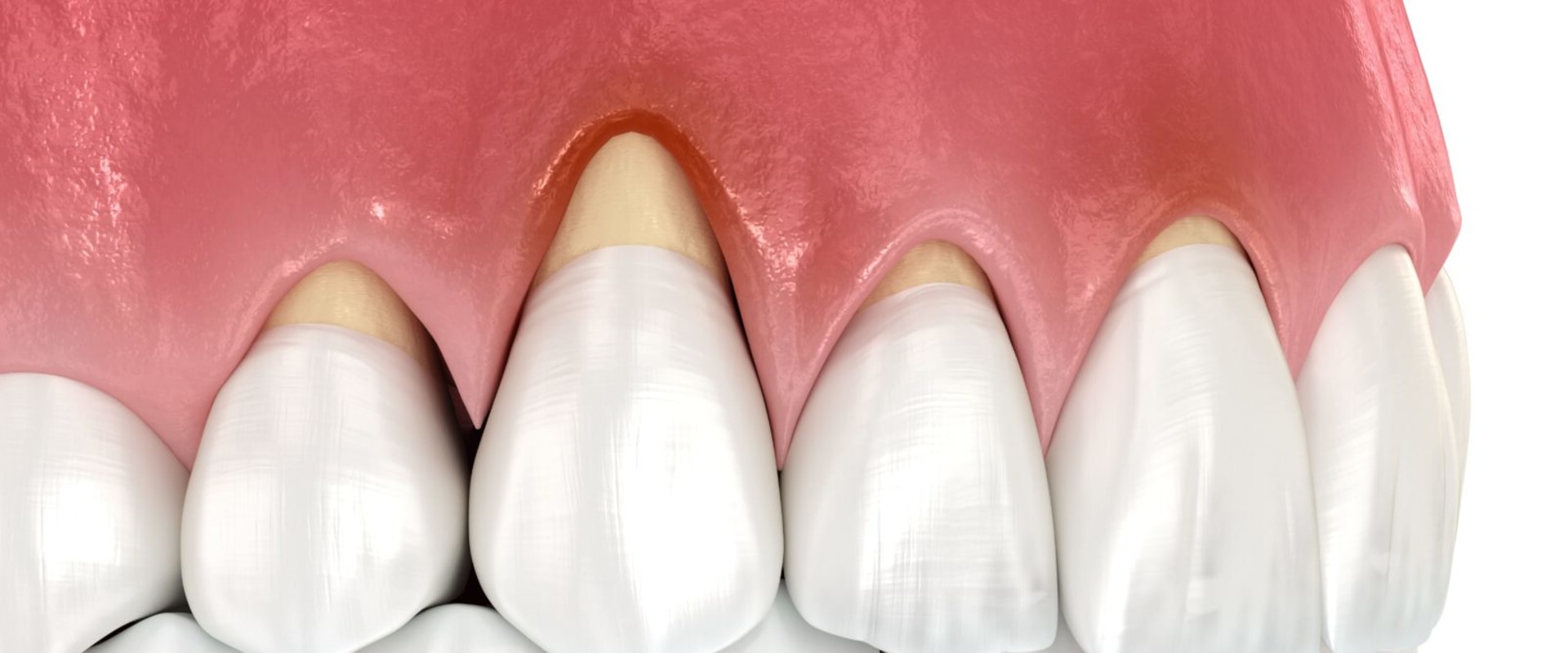 The Impact of Stress on Oral Health: Natural Ways to Protect Your Gums