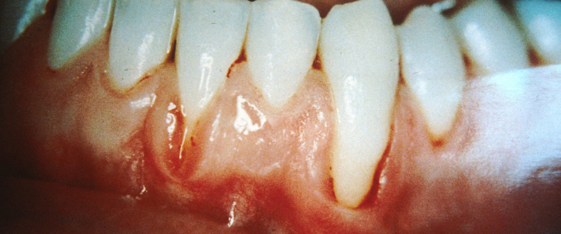 The Power of Saltwater Rinses for Receding Gums