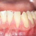 The Power of Vitamin C in Maintaining Healthy Gums: Natural Solutions for Receding Gums
