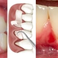 Expert Insights: Natural Ways to Treat Receding Gums