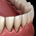 Oil Pulling: The Natural Solution for Receding Gums