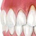 The Impact of Stress on Oral Health: Natural Ways to Protect Your Gums