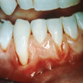 The Power of Saltwater Rinses for Receding Gums
