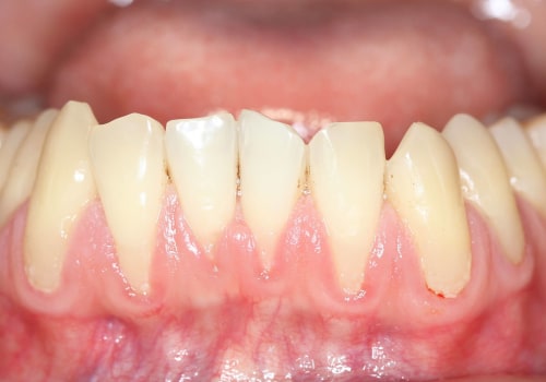 The Power of Vitamin C in Maintaining Healthy Gums: Natural Solutions for Receding Gums