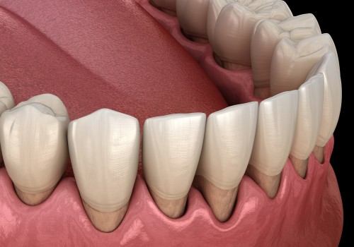 The Truth About Coconut Oil Pulling for Receding Gums: An Expert's Perspective
