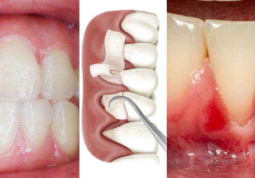 Expert Insights: Natural Ways to Treat Receding Gums