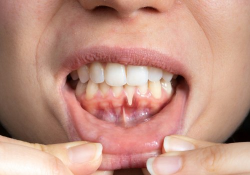 The Connection Between Gum Disease and Receding Gums: Natural Remedies for a Healthy Smile