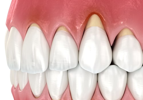 The Impact of Stress on Oral Health: Natural Ways to Protect Your Gums