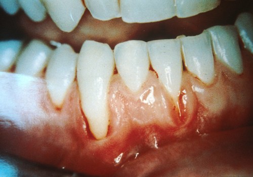 The Power of Saltwater Rinses for Receding Gums